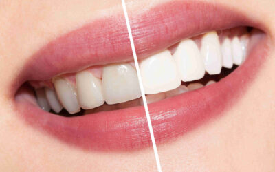 What is a Teeth Whitening and what does it include?