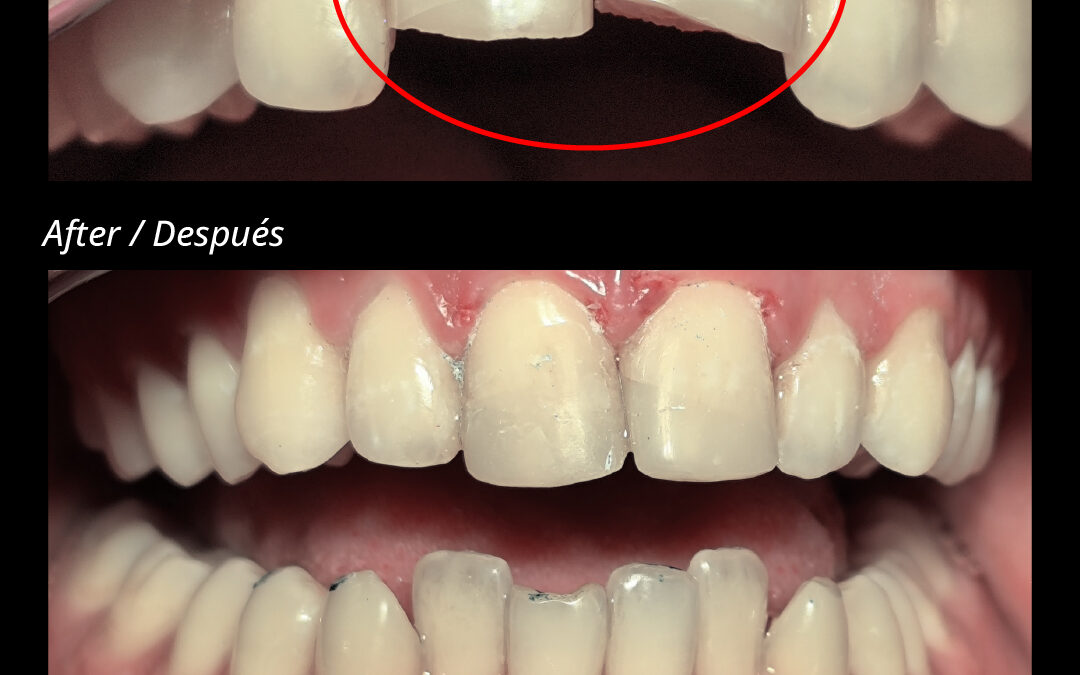 Caso 01: Traumatismo coronario severo (11 y 21) – Endodoncia, postes y coronas de zirconio